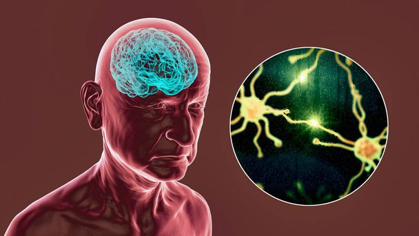 Άνοια, εννοιολογική τρισδιάστατη απεικόνιση που δείχνει ένα ηλικιωμένο άτομο με προοδευτική βλάβη των εγκεφαλικών λειτουργιών, την κατεδάφιση των νευρώνων και των δικτύων τους - Φωτογραφία, εικόνα