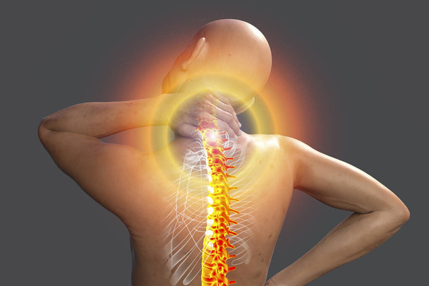 Neck pain, 3D conceptual illustration - Photo, Image