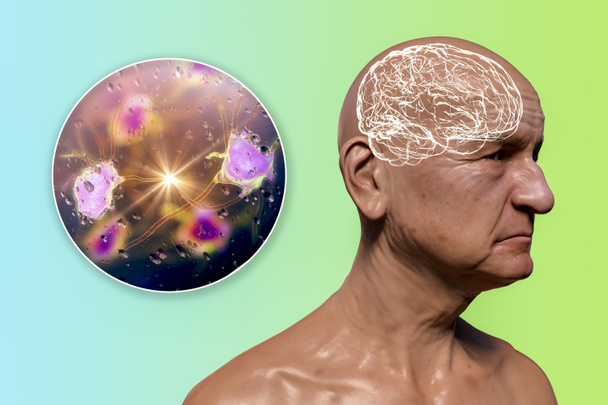 Demencia, koncepcionális 3D-s illusztráció, amely progresszív agyi funkciózavarban szenvedő idős személyt mutat be, a neuronok és hálózataik lerombolását - Fotó, kép