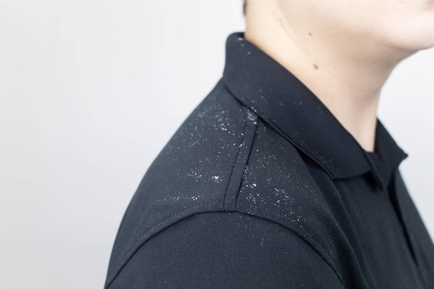 Dandruff on a man's shoulder. Side view of a man who has more dandruff flakes on his black shirt. Scalp disease treatment concept. Discomfort from a fungal infection - Photo, Image