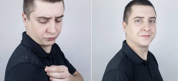 Dandruff before and after. The man on the left shows his shoulder, which has a lot of dandruff. In the photo on the right, the problems with the scalp fungus have disappeared and the man is happy. - Photo, Image