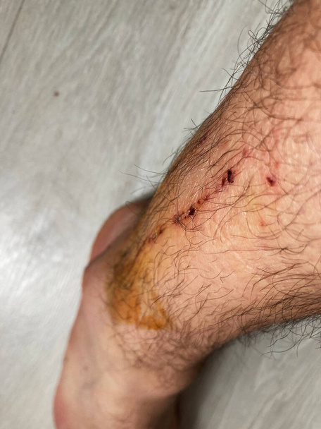 littekens op mannenbenen na ongeval - Foto, afbeelding
