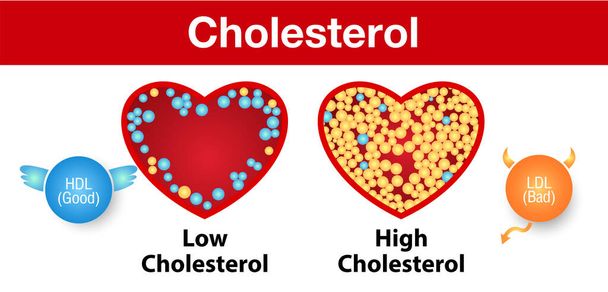 Cholestérol dans l'artère, risque pour la santé, conception vectorielle. - Vecteur, image
