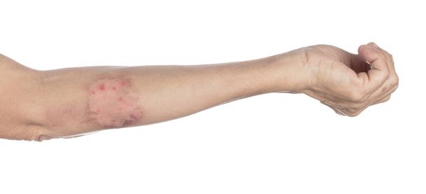 Scalded Skin from Hot Water isolated on a white background - Photo, Image