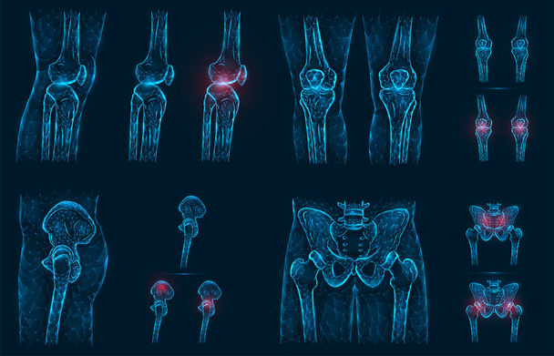Dolor, lesión o inflamación en las rodillas y la pelvis ilustración vectorial poligonal. Modelo polivinílico bajo de una rodilla dolorida, cadera y articulación de cadera. - Vector, imagen