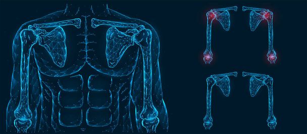 Anatomisches Modell des Menschen. Schmerzen, Verletzungen und Entzündungen der Schulter- und Ellenbogengelenke Vorderseite polygonale Illustration auf blauem Hintergrund. Gesunde und schmerzende Gelenke. - Vektor, Bild