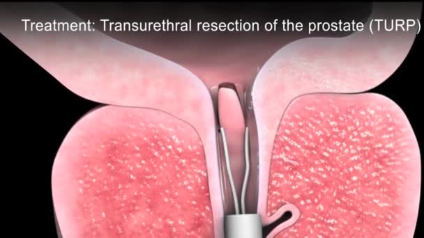 Gutartige Prostatahyperplasie 3D-Animation - Filmmaterial, Video