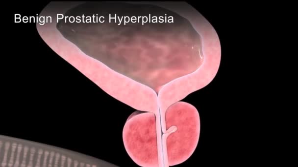 Animación benigna hiperplasia prostática 3d - Imágenes, Vídeo