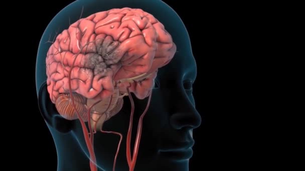 Brain Hemorrhagic Stroke Due To Aneurysm Rupture. - Footage, Video