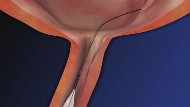A litotripsia é um procedimento médico usado para tratar certos tipos de pedras nos rins e outros órgãos, como a vesícula biliar ou o fígado. - Filmagem, Vídeo