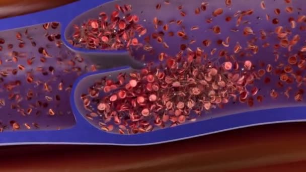 Koagulaatio on prosessi, jossa veri muuttuu nesteestä geeliksi, muodostaen veritulpan.. - Materiaali, video
