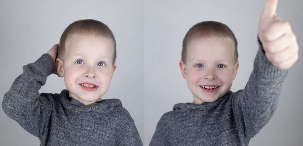 До і після. Дитина показує обличчя з великою кількістю червоних алергічних акне. На другій фотографії видно чисте обличчя без будь-яких алергій. Концепція лікування дитячих висипань. Вітряна віспа
 - Фото, зображення