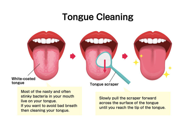 Jak oczyścić ilustrację wektor języka (Zapobieganie cuchnącym oddechom) - Wektor, obraz