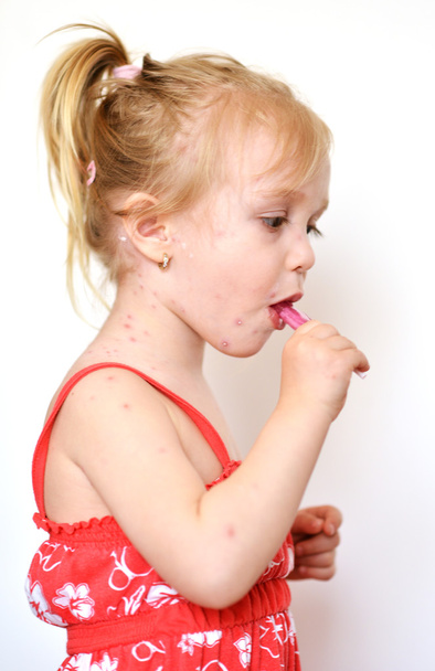 Bambina con eruzione cutanea da varicella
 - Foto, immagini