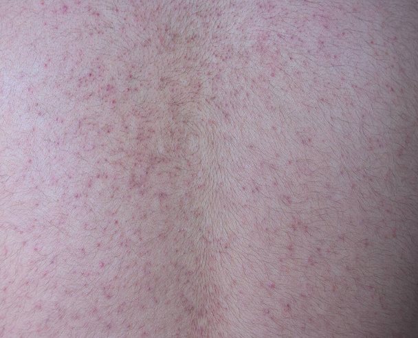 アレルギー性の赤い斑点を持つ人間の皮膚の背景。湿疹アトピー性皮膚炎症状皮膚の背中の男. - 写真・画像