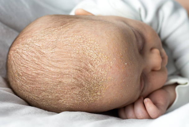dermatitis seborreica costras en la cabeza del bebé. niño con seborrea en el cabello, problemas de la piel del recién nacido - Foto, Imagen