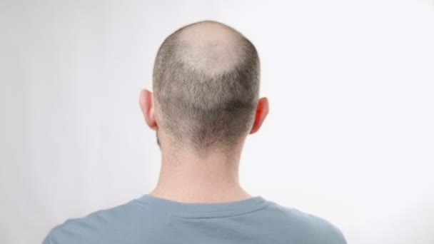 Un hombre con alopecia está acariciando su cabeza con su mano. Vista trasera. El concepto de calvicie y problemas de salud - Imágenes, Vídeo