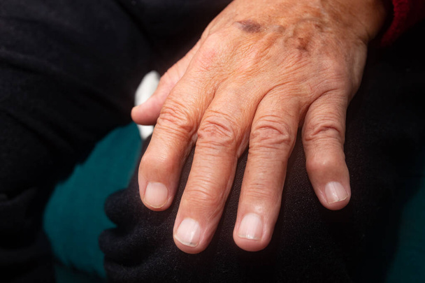 Рука літньої людини з остеоартрозом
 - Фото, зображення