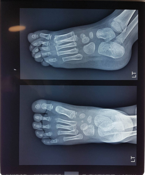 złamane stopy dziecka w doctror podczas badania, tynk na nodze - Zdjęcie, obraz