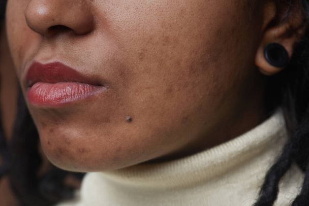 Extreme close-up portret van echte Afro-Amerikaanse vrouw met post acne vlekken en onvolkomenheden van de huid - Foto, afbeelding