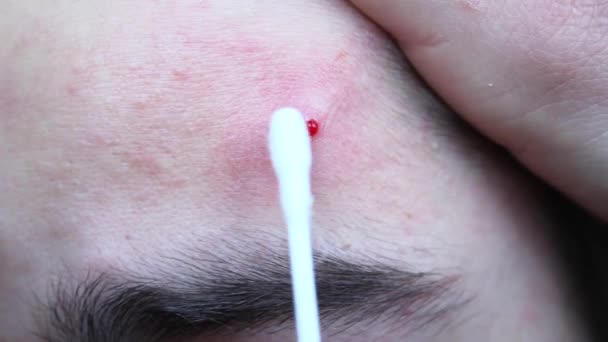 Problematic skin in a young man with dark hair. Acne on the forehead. Problem of teenage acne and pimples on face skin. Rubs oily problem skin with a cotton swab. - Footage, Video