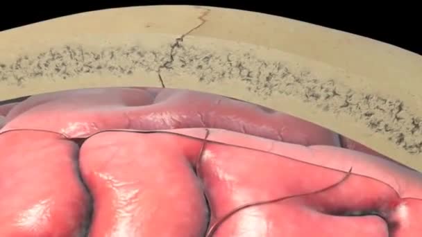 Obraz mozku krvácejícího přes lebku - Záběry, video