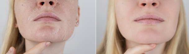 До і після. Жінка оглядає суху шкіру на обличчі. Пілінг, грубість, дискомфорт, чутливість шкіри. Пацієнт за призначенням дерматолога або косметолога. Крупним планом шматочки сухої шкіри
 - Фото, зображення