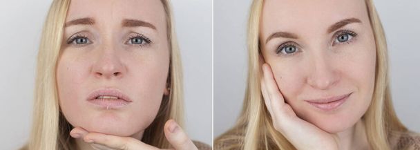 Antes y después. Una mujer examina la piel seca de sus labios. Peeling, grosor, molestias, sensibilidad de la piel. Paciente en la cita de un dermatólogo o cosmetólogo. Primer plano de los trozos de piel seca - Foto, imagen