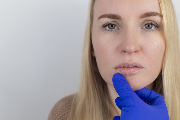 Eine Frau untersucht trockene Haut auf ihren Lippen. Peeling, Grobheit, Unwohlsein, Hautempfindlichkeit. Patient beim Termin beim Dermatologen oder Kosmetologen. Nahaufnahme von Stücken trockener Haut - Foto, Bild