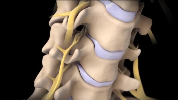 椎間ディスクの破裂により骨に圧力をかけ骨損傷が発生します. - 映像、動画