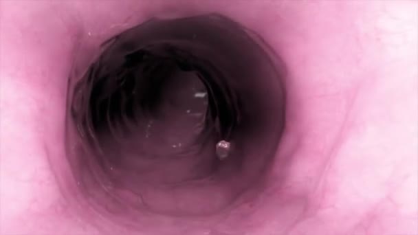 Cólon durante uma enteroscopia com um tumor de câncer intestinal ou intestinal visível. - Filmagem, Vídeo