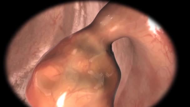 患者の消化管の大腸内視鏡生検 - 映像、動画