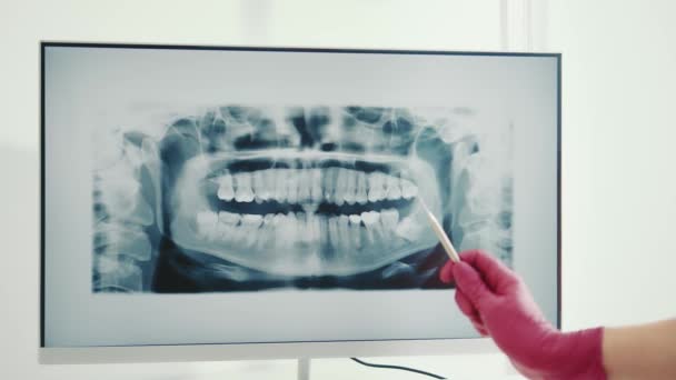 Zubař vyšetřuje panoramatický rentgen zubů. Zubař ukazuje problém zubů na rentgenu zubů s jeho prstem. - Záběry, video