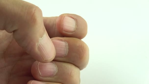 Вертикальные гребни на ногтях симптомов дефицита витаминов и минералов. Вид сверху мужской руки с линией на ногтях на белом фоне. - Кадры, видео