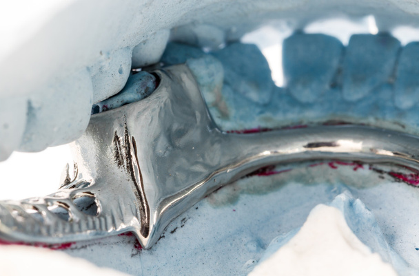 石膏型に部分床義歯 - 写真・画像