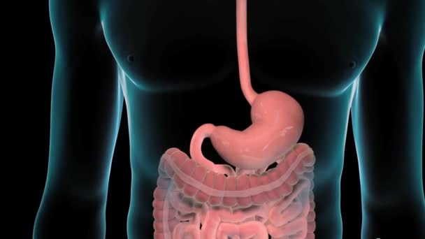 Las úlceras gástricas y duodenales son dos tipos de úlceras pépticas. Una úlcera péptica es una llaga que se encuentra en el interior del estómago que recubre una úlcera gástrica o en la parte superior del intestino delgado una úlcera duodenal. - Imágenes, Vídeo