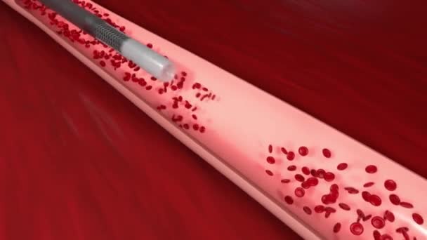 Damar tıkanıklığı genellikle pıhtılaşmayla oluşan bir kan damarının tıkanıklığıdır.. - Video, Çekim