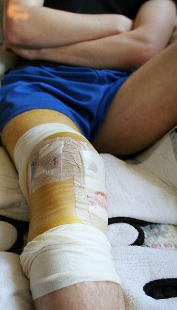Injured leg and knee in bandages after operation. bloody limb in hospital cast - Photo, Image