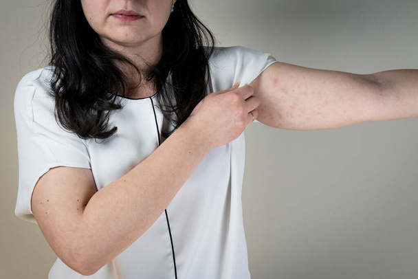 Women with symptoms of itchy urticaria or allergic reaction on the skin. Red rash on the females body. Concepts of allergy, skin diseases and health care. - Photo, Image