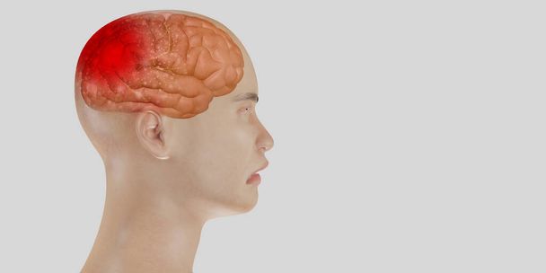 Hoofdpijn hersenen systeem problemen schedelpijn gezicht man met hoofdpijn 3d illustratie - Foto, afbeelding