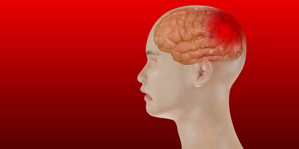 Πονοκέφαλος του εγκεφάλου προβλήματα του κρανιακού πόνου πρόσωπο άνθρωπος δείχνει πονοκεφάλους 3d εικονογράφηση - Φωτογραφία, εικόνα