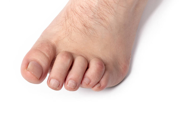 studio lighting. a human leg on a white background. The finger is strongly curved, deformed. Close-up - Photo, Image