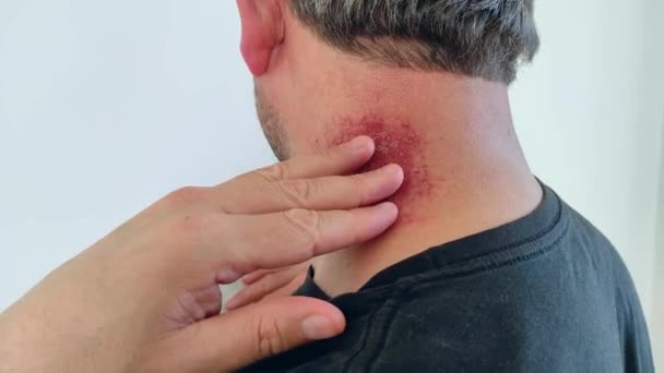 Un uomo che è arrossato e ferito dopo rigidità muscolare nella zona del collo, - Filmati, video