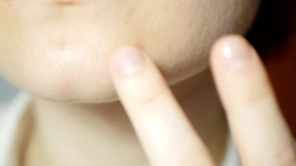 Close-up vrouw aanbrengen van anti acne crème. Dermatologische cosmetica  - Video