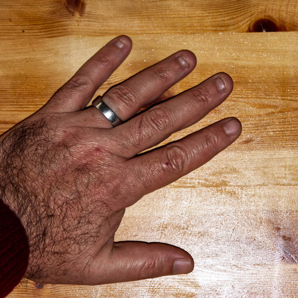 close-up of a mans hand with obsessive compulsive onychophagy disorder - Photo, Image