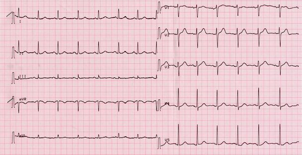 elektrocardiogram van hartslag - Foto, afbeelding