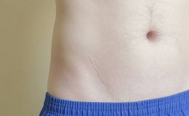 Joven con una cicatriz en el estómago después de la eliminación de la apendicitis - Foto, imagen