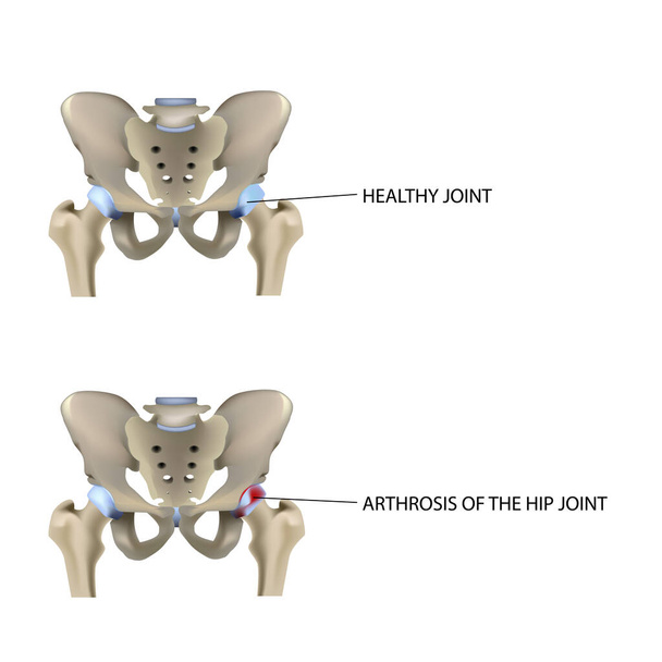 Arthrite de la hanche, vecteur d'illustration médicale vectorielle - Vecteur, image