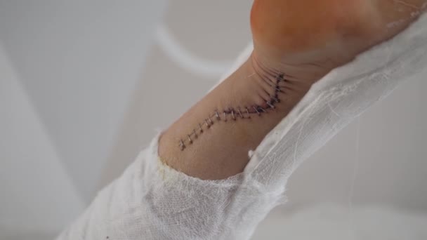 Primer plano de la costura con tirantes en la pierna después de la cirugía en el tendón de Aquiles - Metraje, vídeo