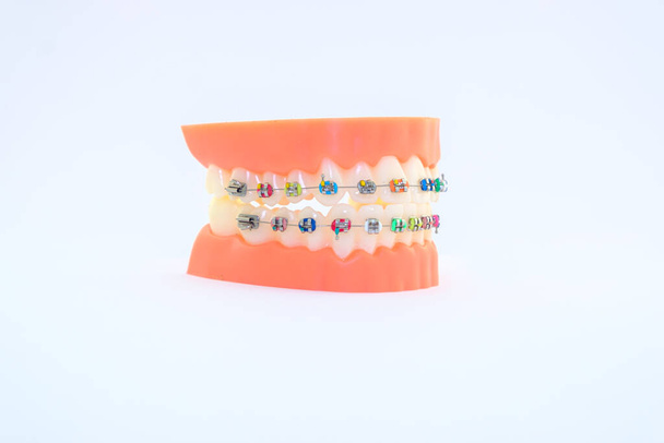 白い背景に隔離された歯の色鮮やかなブラケット - 写真・画像